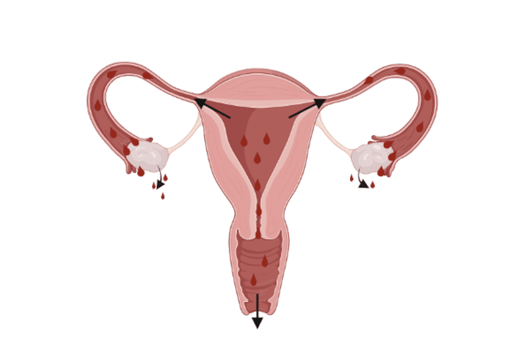 Endométriose : douleurs, règles, causes - ce qu'il faut savoir !