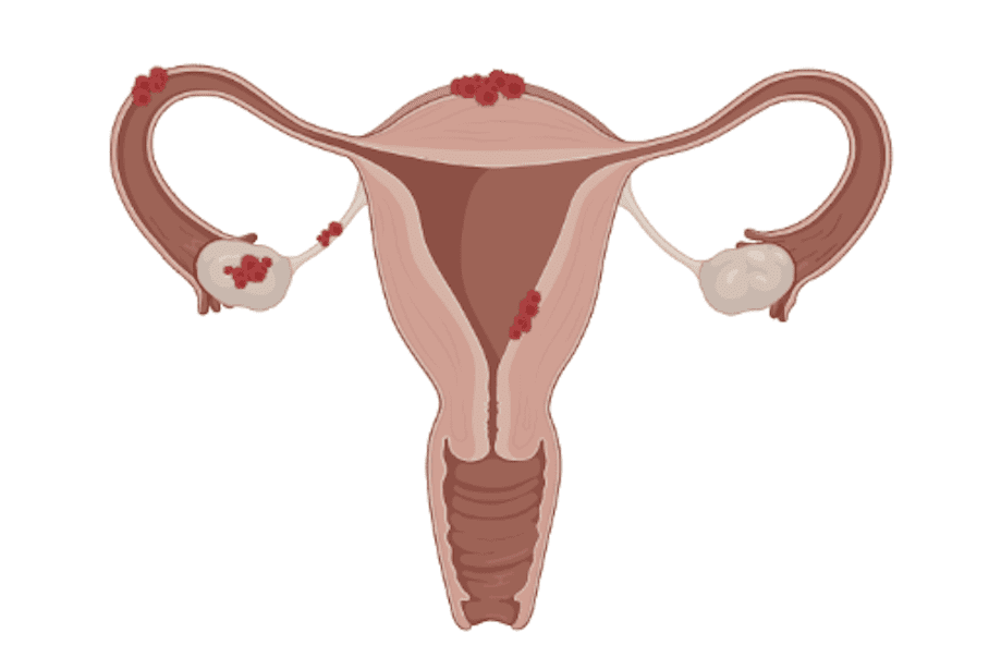 Endométriose : douleurs, règles, causes - ce qu'il faut savoir !